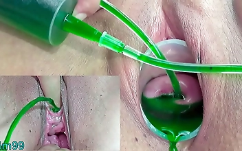 Japanese Lesbians' Cervix and Pee Hole Inflation with Injections - A Must-Watch!